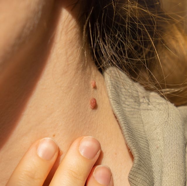 Skin Tag Removal